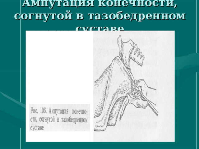 Ампутация конечности, согнутой в тазобедренном суставе 