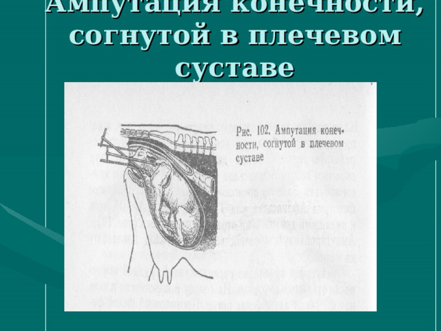 Ампутация конечности, согнутой в плечевом суставе 