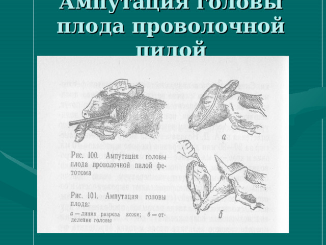 Ампутация головы плода проволочной пилой 