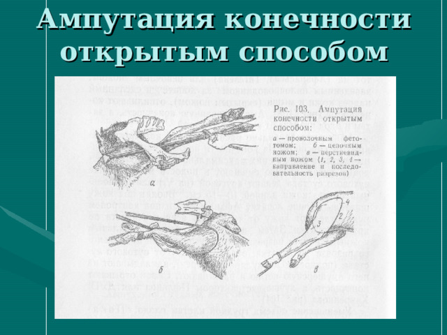 Ампутация конечности открытым способом 