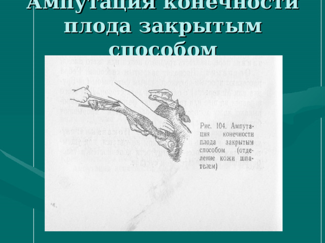 Ампутация конечности плода закрытым способом 