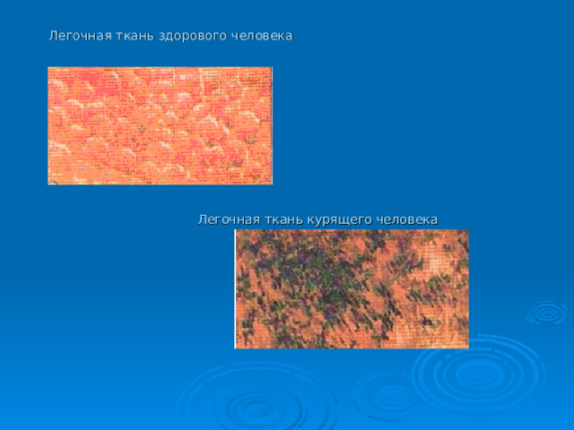 Легочная ткань здорового человека  Легочная ткань курящего человека 
