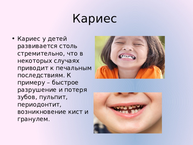Кариес Кариес у детей развивается столь стремительно, что в некоторых случаях приводит к печальным последствиям. К примеру – быстрое разрушение и потеря зубов, пульпит, периодонтит, возникновение кист и гранулем. 