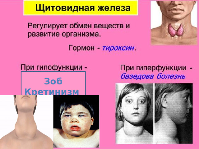 Зоб Кретинизм 