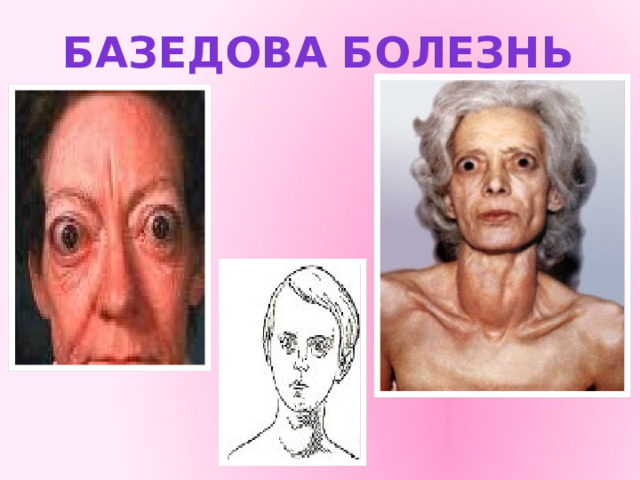 Базедова болезнь 