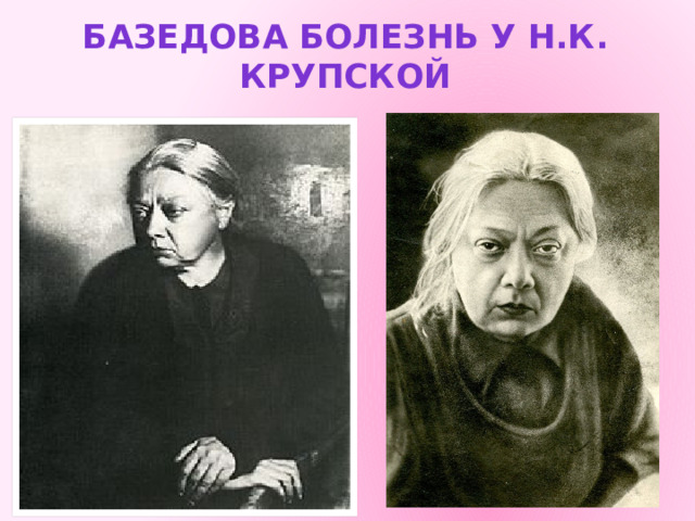 Базедова болезнь у Н.К. Крупской 