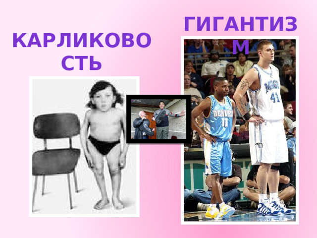 Гигантизм Карликовость 