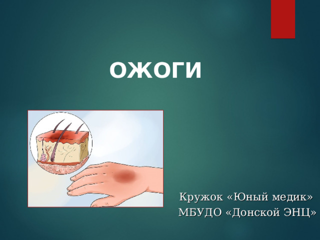 ОЖОГИ Кружок «Юный медик» МБУДО «Донской ЭНЦ» 