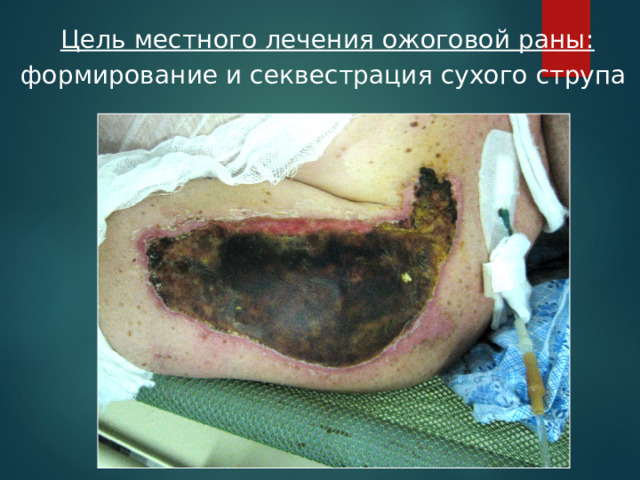  Цель местного лечения ожоговой раны:  формирование и секвестрация сухого струпа 