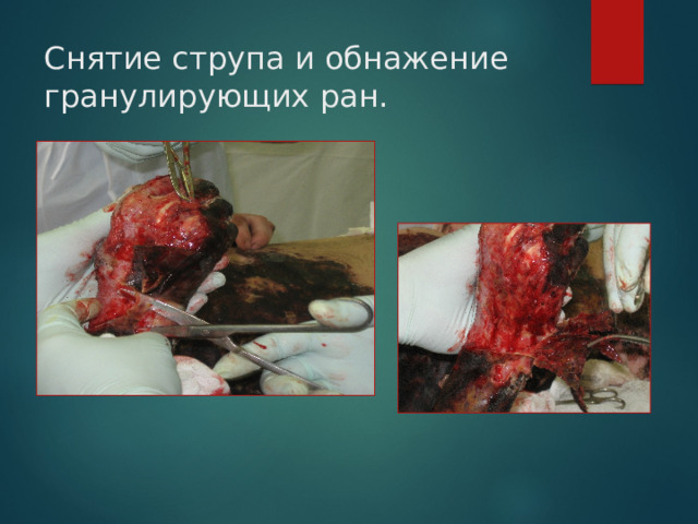 Снятие струпа и обнажение гранулирующих ран. 