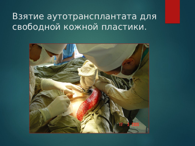 Взятие аутотрансплантата для свободной кожной пластики. 
