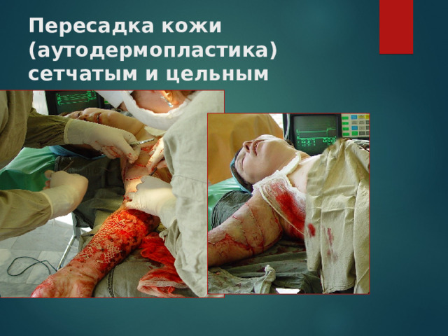 Пересадка кожи (аутодермопластика) сетчатым и цельным лоскутом 