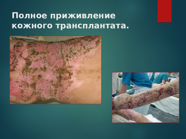Полное приживление кожного трансплантата. 
