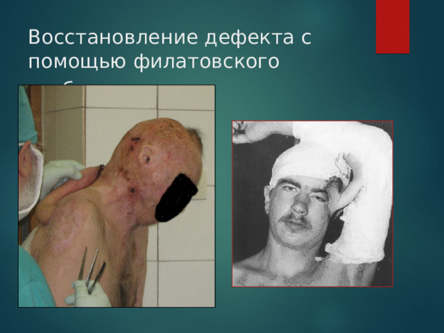Восстановление дефекта с помощью филатовского стебля . 