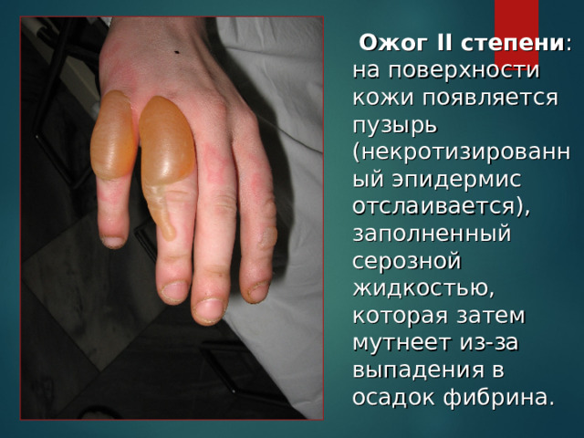  Ожог II степени : на поверхности кожи появляется пузырь (некротизированный эпидермис отслаивается), заполненный серозной жидкостью, которая затем мутнеет из-за выпадения в осадок фибрина. 
