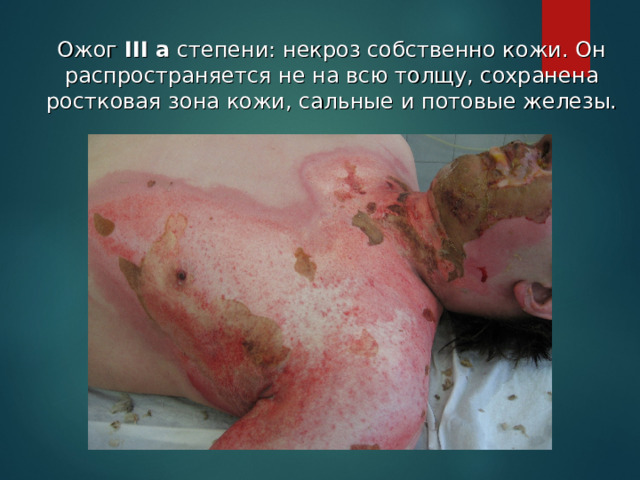  Ожог III а степени: некроз собственно кожи. Он распространяется не на всю толщу, сохранена ростковая зона кожи, сальные и потовые железы. 