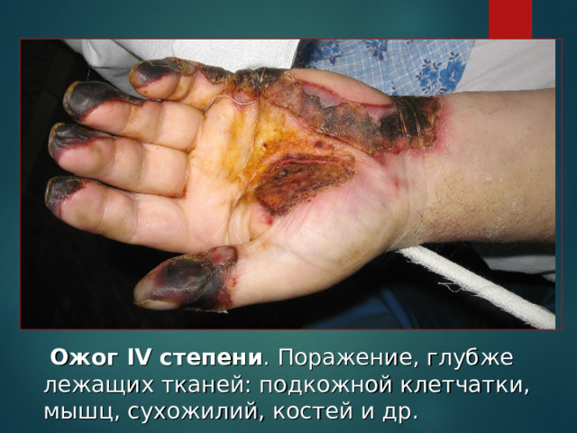  Ожог IV степени . Поражение, глубже лежащих тканей: подкожной клетчатки, мышц, сухожилий, костей и др. 