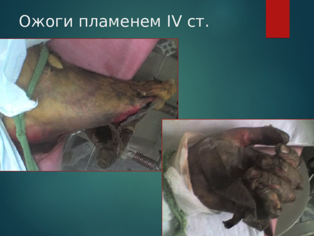 Ожоги пламенем IV ст. 
