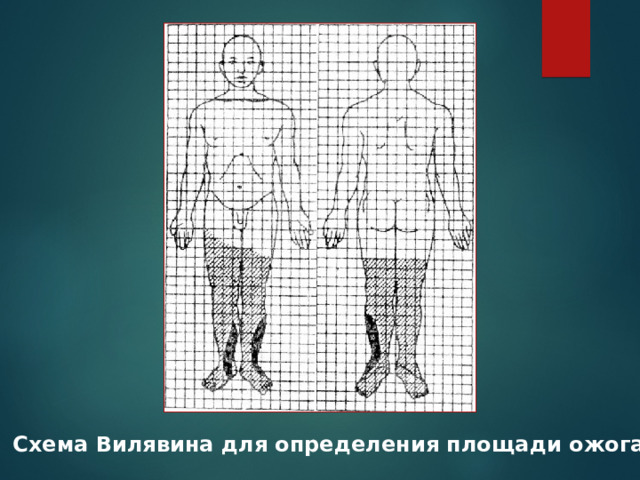 Схема Вилявина для определения площади ожога 