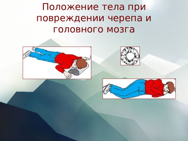 Положение тела при повреждении черепа и головного мозга 