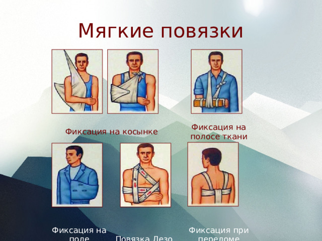 Мягкие повязки                                                   Фиксация на косынке                                                   Фиксация на  поле пиджака Фиксация на  полосе ткани                                                   Повязка Дезо Фиксация при  переломе ключицы 