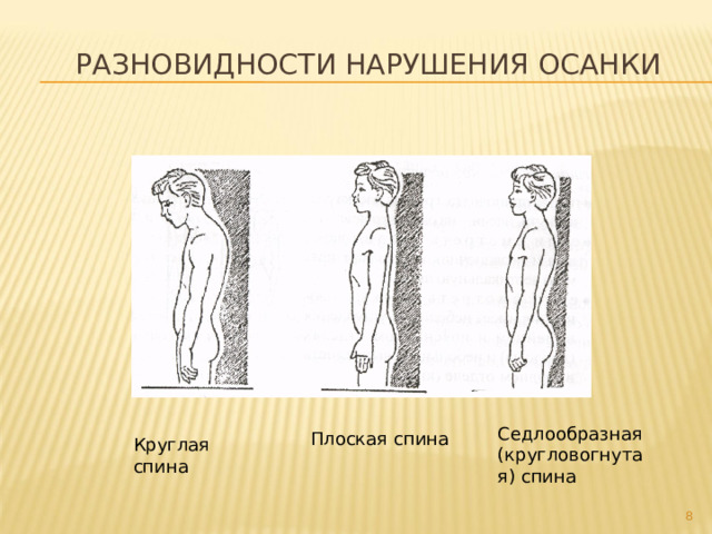  Разновидности нарушения осанки Седлообразная (кругловогнутая) спина Плоская спина Круглая спина  