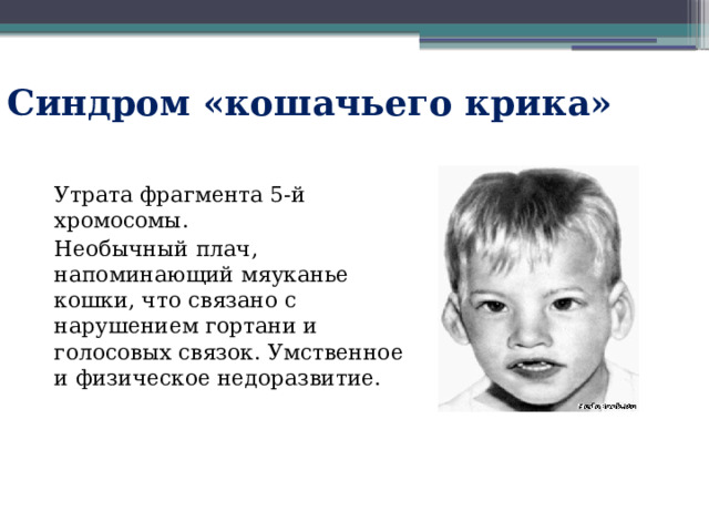 Синдром «кошачьего крика» Утрата фрагмента 5-й хромосомы. Необычный плач, напоминающий мяуканье кошки, что связано с нарушением гортани и голосовых связок. Умственное и физическое недоразвитие. 