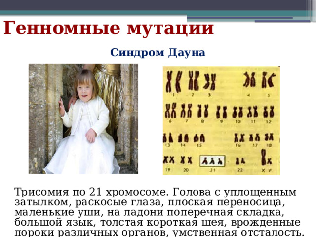 Генномные мутации Синдром Дауна Трисомия по 21 хромосоме. Голова с уплощенным затылком, раскосые глаза, плоская переносица, маленькие уши, на ладони поперечная складка, большой язык, толстая короткая шея, врожденные пороки различных органов, умственная отсталость. 