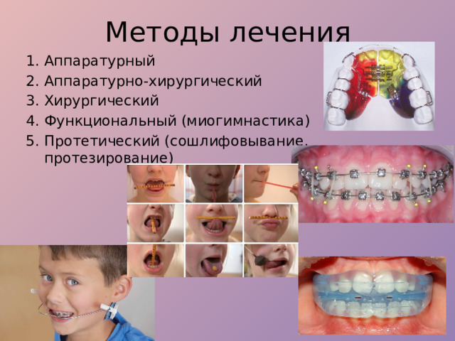 Методы лечения Аппаратурный Аппаратурно-хирургический Хирургический Функциональный (миогимнастика) Протетический (сошлифовывание, протезирование) 