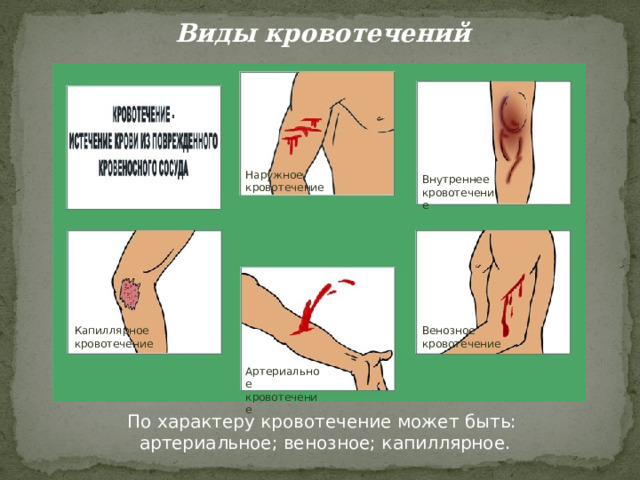 Виды кровотечений Наружное кровотечение Внутреннее кровотечение Венозное кровотечение Капиллярное кровотечение Артериальное кровотечение По характеру кровотечение может быть: артериальное; венозное; капиллярное. 