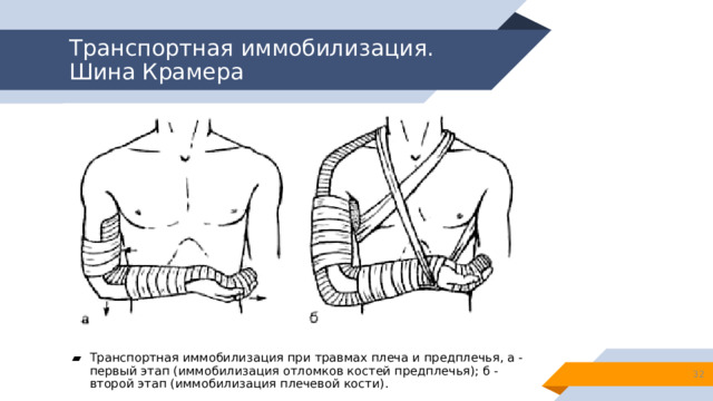 Транспортная иммобилизация.  Шина Крамера Транспортная иммобилизация при травмах плеча и предплечья, а - первый этап (иммобилизация отломков костей предплечья); б - второй этап (иммобилизация плечевой кости). 13 