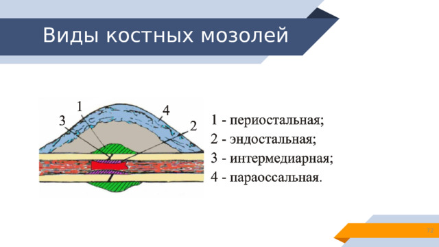 Виды костных мозолей 13 
