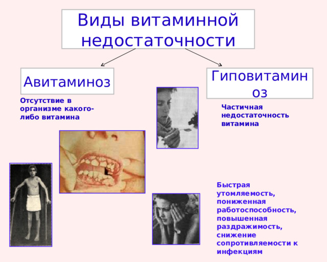 Виды витаминной недостаточности Авитаминоз Гиповитаминоз Отсутствие в организме какого-либо витамина Частичная недостаточность витамина Быстрая утомляемость, пониженная работоспособность, повышенная раздражимость, снижение сопротивляемости к инфекциям 