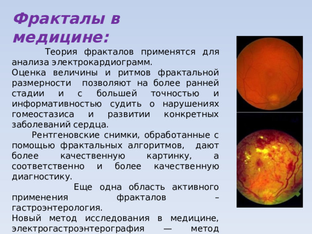 Фракталы в медицине:  Теория фракталов применятся для анализа электрокардиограмм. Оценка величины и ритмов фрактальной размерности позволяют на более ранней стадии и с большей точностью и информативностью судить о нарушениях гомеостазиса и развитии конкретных заболеваний сердца.  Рентгеновские снимки, обработанные с помощью фрактальных алгоритмов, дают более качественную картинку, а соответственно и более качественную диагностику.  Еще одна область активного применения фракталов – гастроэнтерология. Новый метод исследования в медицине, электрогастроэнтерография — метод исследования, позволяющий оценить биоэлектрическую активность желудка, двенадцатиперстной кишки и других отделов ЖКТ. 