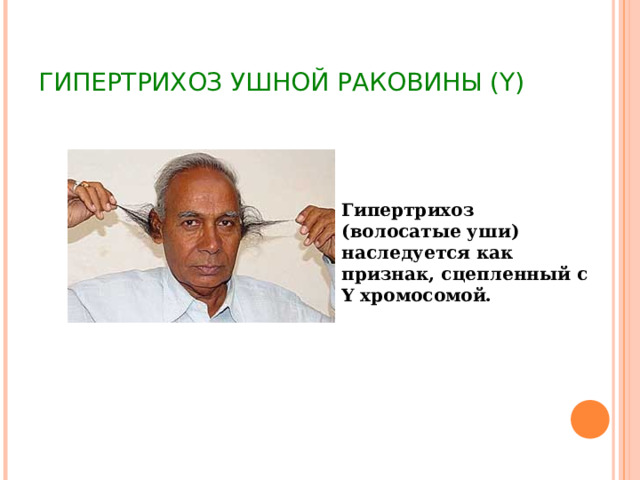 ГИПЕРТРИХОЗ  УШНОЙ РАКОВИНЫ ( Y) Гипертрихоз (волосатые уши) наследуется как признак, сцепленный с Y хромосомой. 