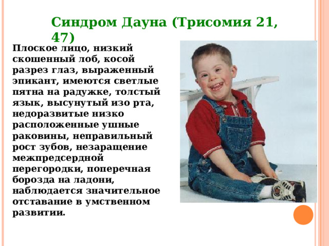 Синдром Дауна (Трисомия 21, 47) Плоское лицо, низкий скошенный лоб, косой разрез глаз, выраженный эпикант, имеются светлые пятна на радужке, толстый язык, высунутый изо рта, недоразвитые низко расположенные ушные раковины, неправильный рост зубов, незаращение межпредсердной перегородки, поперечная борозда на ладони, наблюдается значительное отставание в умственном развитии.   