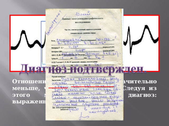 Отношение t d к t s оказалось значительно меньше, чем золотое сечение. Следуя из этого можно поставить диагноз: выраженная тахикардия.  