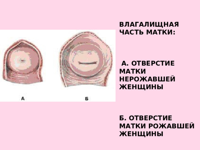    Влагалищная часть матки:       А. Отверстие матки нерожавшей женщины       Б. Отверстие матки рожавшей женщины   