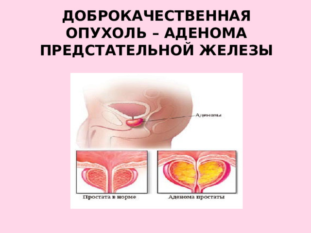 доброкачественная опухоль – аденома предстательной железы 