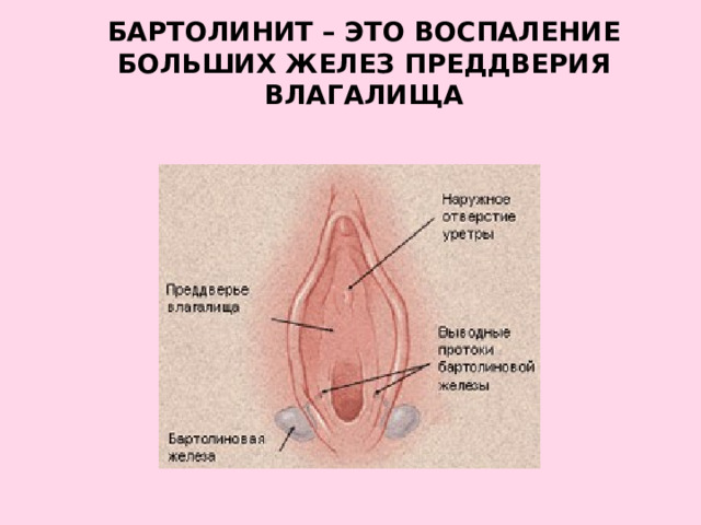 БАРТОЛИНИТ – это воспаление больших желез преддверия влагалища   