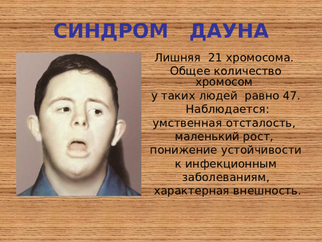 СИНДРОМ ДАУНА Лишняя 21 хромосома. Общее количество хромосом у таких людей равно 47.  Наблюдается: умственная отсталость, маленький рост, понижение устойчивости  к инфекционным заболеваниям,  характерная внешность. 
