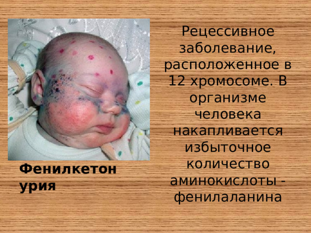 Рецессивное заболевание, расположенное в 12 хромосоме. В организме человека накапливается избыточное количество аминокислоты - фенилаланина Фенилкетонурия 
