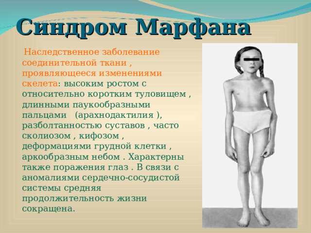 Синдром Марфана  Наследственное заболевание соединительной ткани , проявляющееся изменениями скелета : высоким ростом с относительно коротким туловищем , длинными паукообразными пальцами (арахнодактилия ), разболтанностью суставов , часто сколиозом , кифозом , деформациями грудной клетки , аркообразным небом . Характерны также поражения глаз . В связи с аномалиями сердечно-сосудистой системы средняя продолжительность жизни сокращена. 