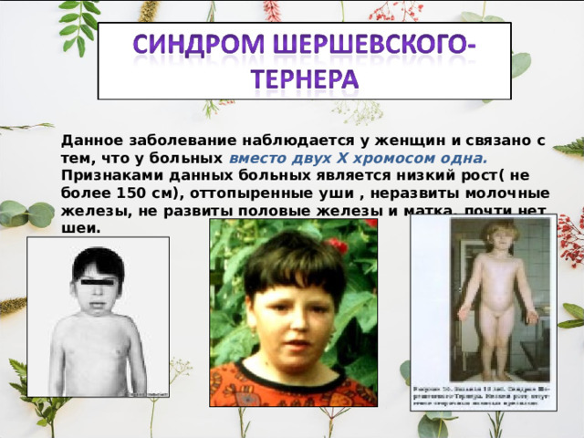 Данное заболевание наблюдается у женщин и связано с тем, что у больных вместо двух Х хромосом одна. Признаками данных больных является низкий рост( не более 150 см), оттопыренные уши , неразвиты молочные железы, не развиты половые железы и матка, почти нет шеи. 