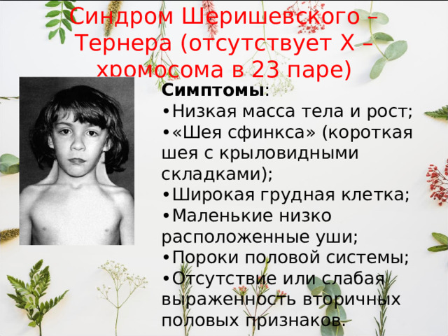 Синдром Шеришевского –Тернера (отсутствует Х – хромосома в 23 паре) Симптомы : • Низкая масса тела и рост; • «Шея сфинкса» (короткая шея с крыловидными складками); • Широкая грудная клетка; • Маленькие низко расположенные уши; • Пороки половой системы; • Отсутствие или слабая выраженность вторичных половых признаков. 