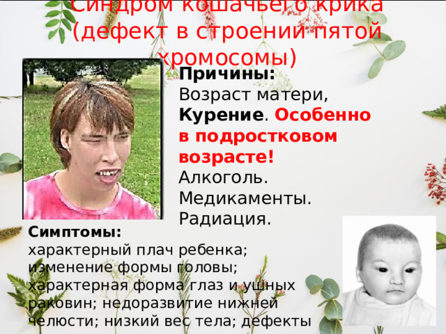 Синдром кошачьего крика (дефект в строении пятой хромосомы) Причины: Возраст матери, Курение . Особенно в подростковом возрасте! Алкоголь. Медикаменты. Радиация. Симптомы: характерный плач ребенка; изменение формы головы; характерная форма глаз и ушных раковин; недоразвитие нижней челюсти; низкий вес тела; дефекты развития пальцев; косолапость. 