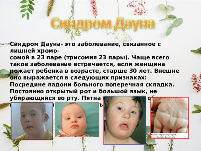 Синдром Дауна- это заболевание, связанное с лишней хромо- сомой в 23 паре (трисомия 23 пары). Чаще всего такое заболевание встречается, если женщина рожает ребенка в возрасте, старше 30 лет. Внешне оно выражается в следующих признаках: Посредине ладони больного поперечная складка. Постоянно открытый рот и большой язык, не убирающийся во рту. Пятна на радужной оболочке глаз. Умственная отсталость. 