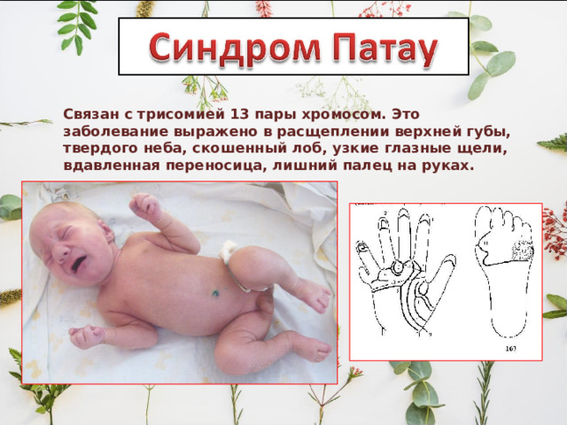Связан с трисомией 13 пары хромосом. Это заболевание выражено в расщеплении верхней губы, твердого неба, скошенный лоб, узкие глазные щели, вдавленная переносица, лишний палец на руках. 