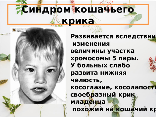 Синдром кошачьего крика Развивается вследствии  изменения величины участка хромосомы 5 пары. У больных слабо развита нижняя челюсть, косоглазие, косолапость, своебразный крик младенца  похожий на кошачий крик 