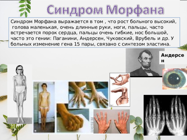 Синдром Морфана выражается в том , что рост больного высокий,  голова маленькая, очень длинные руки, ноги, пальцы, часто встречается порок сердца, пальцы очень гибкие, нос большой, часто это гении: Паганини, Андерсен, Чуковский, Врубель и др. У больных изменение гена 15 пары, связано с синтезом эластина. Андерсен 